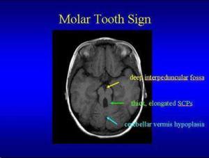 Molar tooth sign