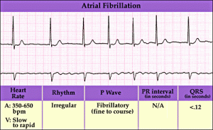 Atrial fibrilation